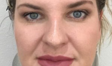 Injectables After Results