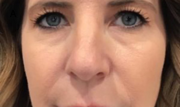 Injectables After Results