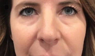 Injectables Before Results