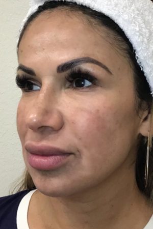 Real patient after Chemical Peels procedure