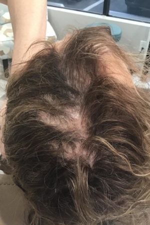 Real patient before PRP Hair Loss Treatment procedure