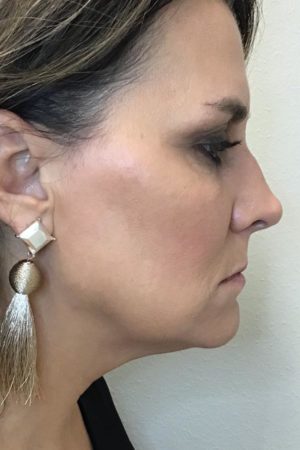 Real patient after KYBELLA® procedure
