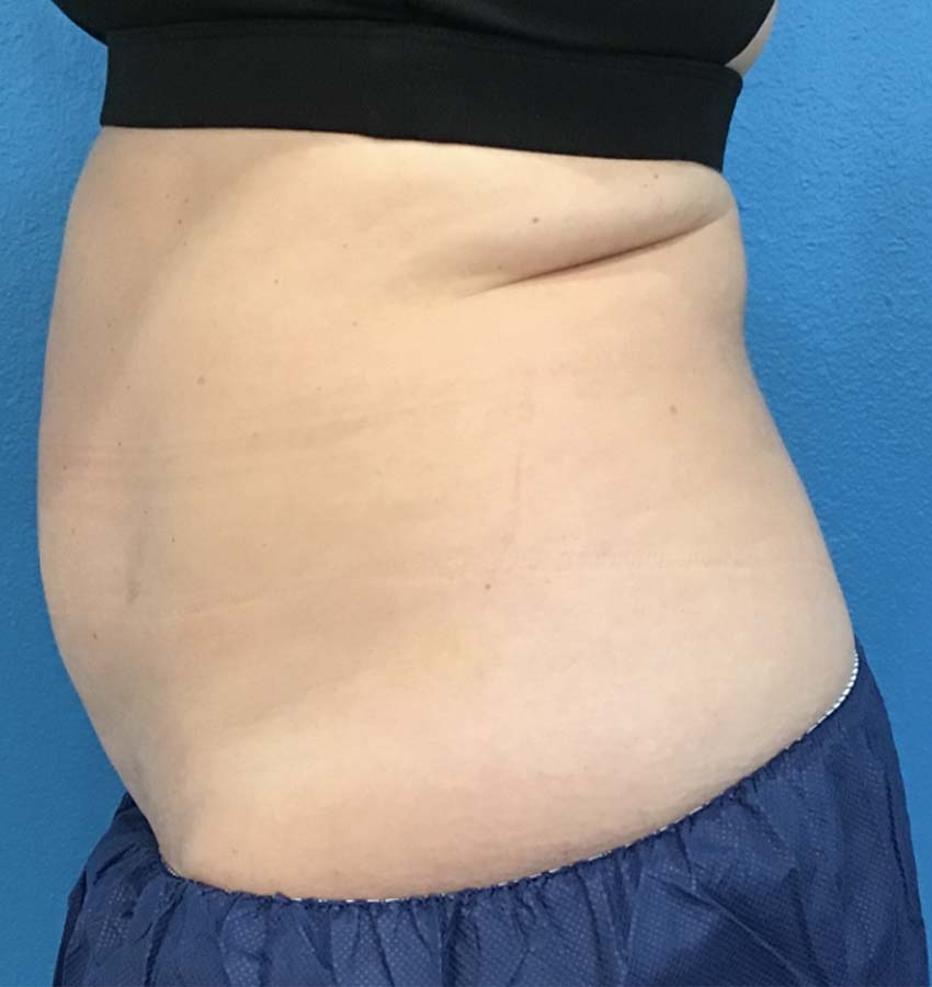 Coolsculpting