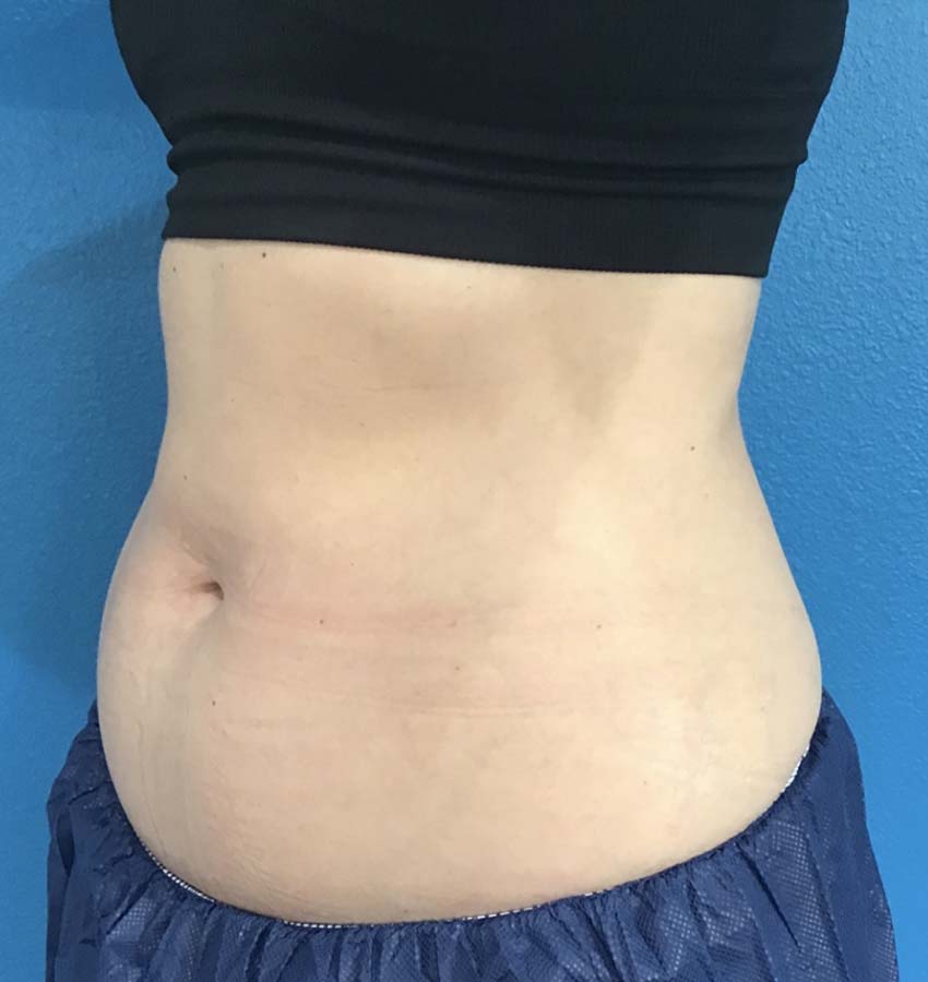 Coolsculpting