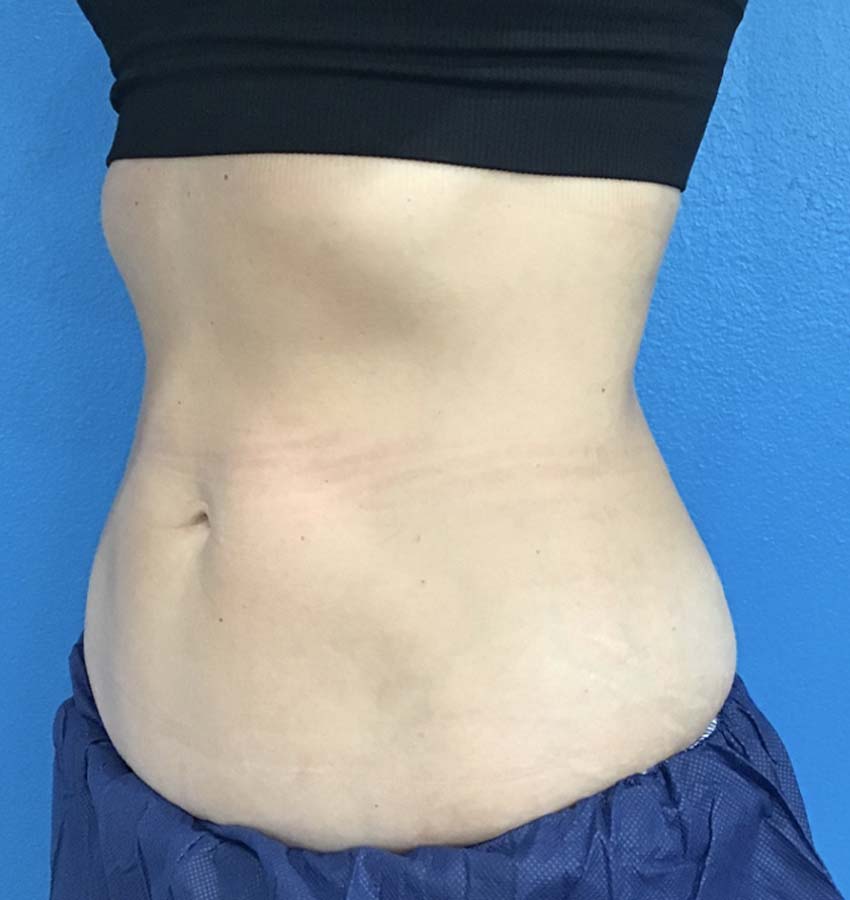 Coolsculpting