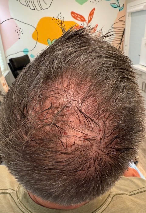 Exosome For Hair Loss