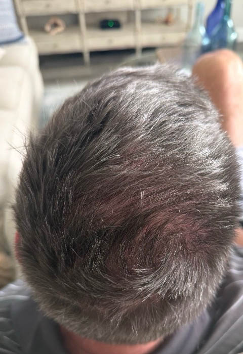 Exosome For Hair Loss